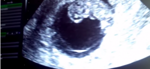 Baby Robertson 9w4d